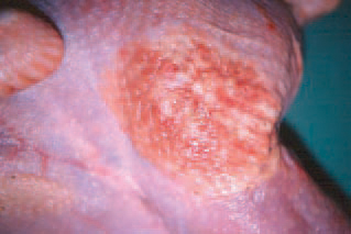 colibacilose